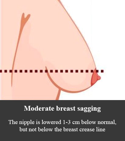 Breast sagging