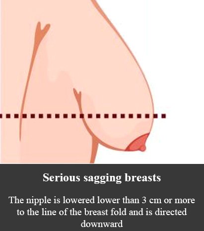 Breast sagging