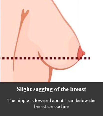 Breast sagging
