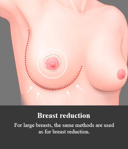 method 3