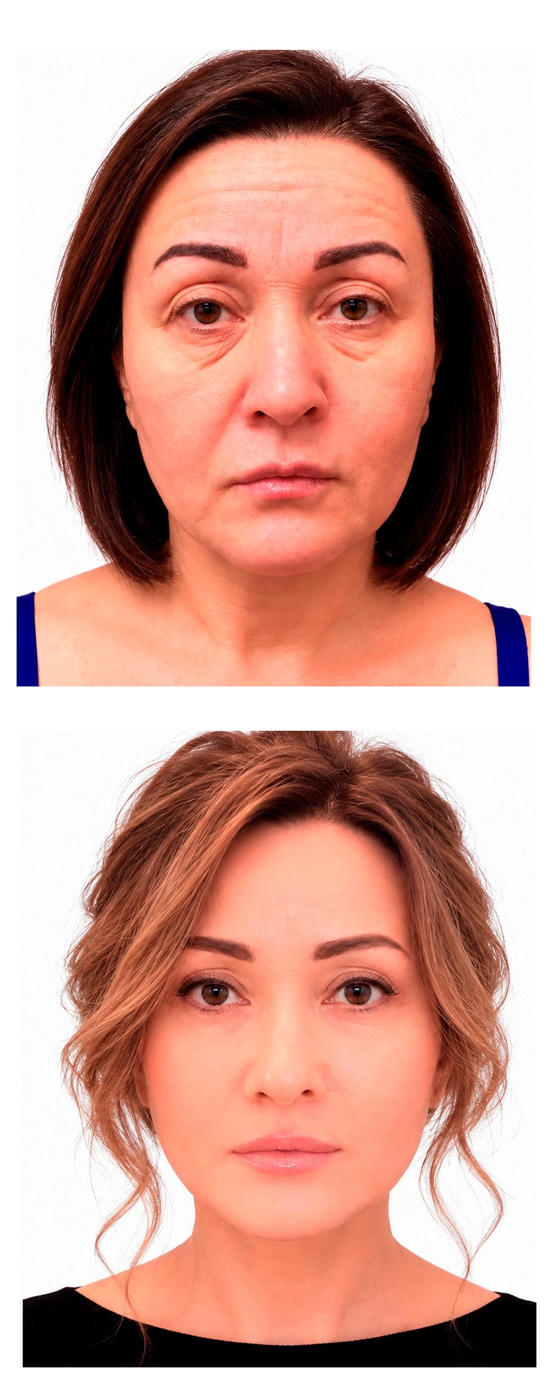 Facial rejuvenation before and after - patient 1
