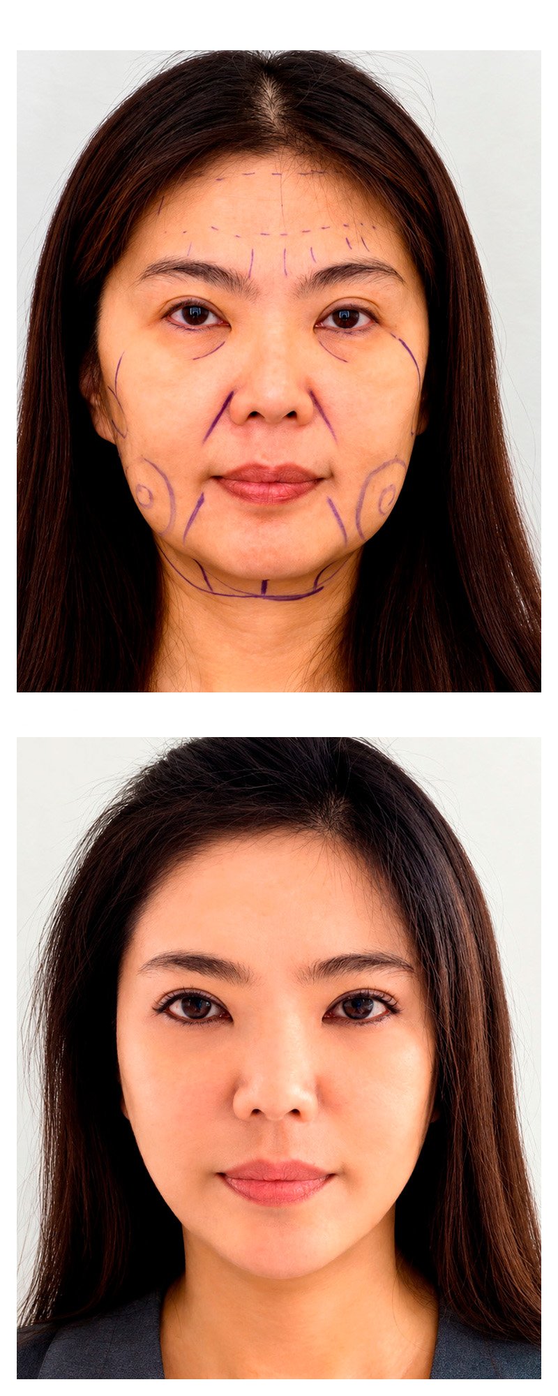 Facial rejuvenation before and after - patient 2