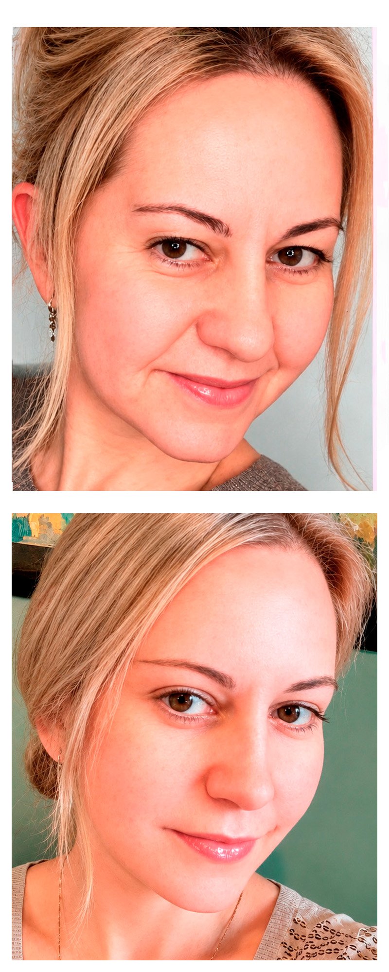 Facial rejuvenation before and after - patient 3